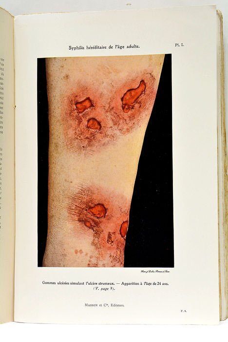 Syphilis héréditaire de l'age adulte. Avec 24 planches hors texte, …