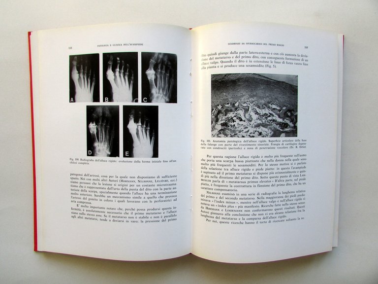 A. Viladot Patologia e Clinica dell'Avampiede Verduci Roma 1975