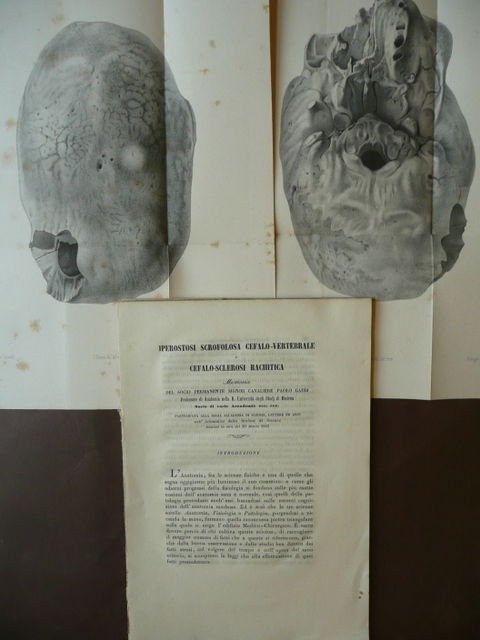 Medicina Iperostosi Scrofolosa Cefalo-Vertebrale Sclerosi Rachitica Gaddi