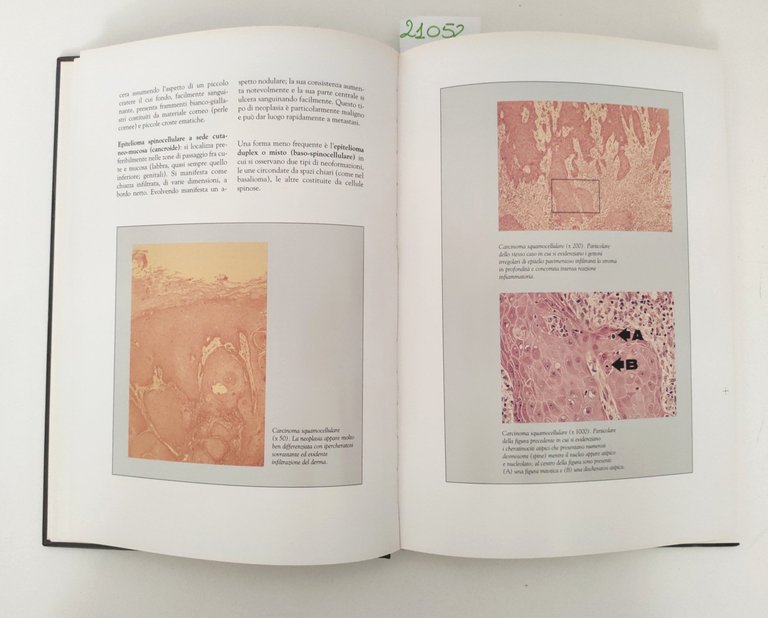 A. Morresi Tumori epiteliali maligni della cute Atlante topografico 2 …