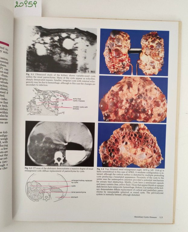 Aa. Vv. Cystic and dysplastic lesion of the kindey Gower … | Immagine Gallery 2