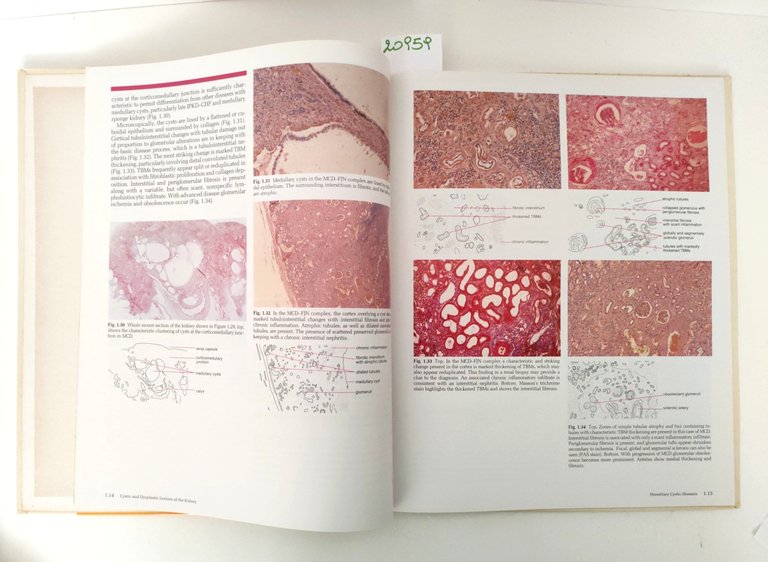 Aa. Vv. Cystic and dysplastic lesion of the kindey Gower … | Immagine Gallery 3