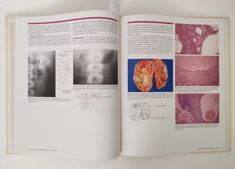 Aa. Vv. Cystic and dysplastic lesion of the kindey Gower … | Immagine Gallery 4