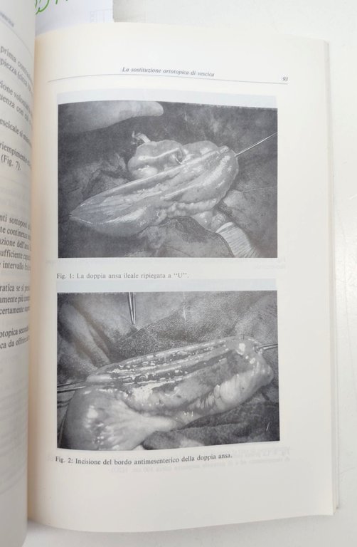 Alcini D'Addessi Sostituzione ortotopica di vescica 1990