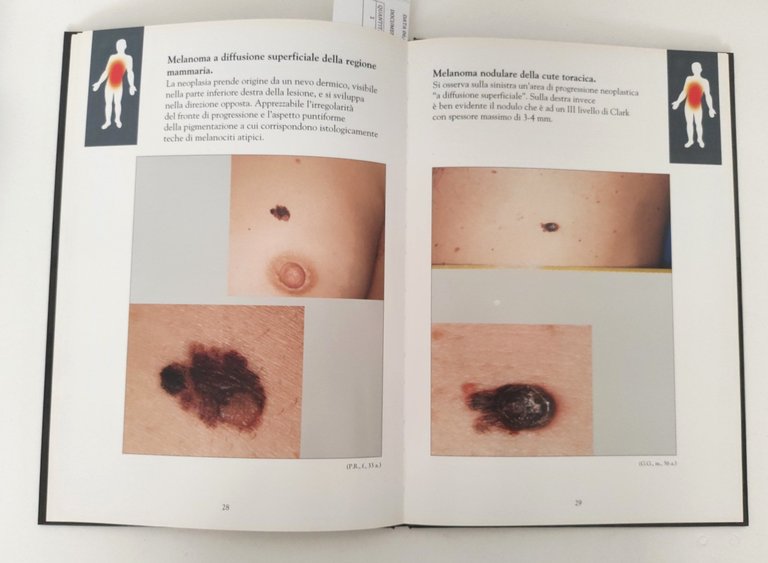 Arcangelo Morresi Melanoma della cute Atlante topografico 2 volumi Cilag …