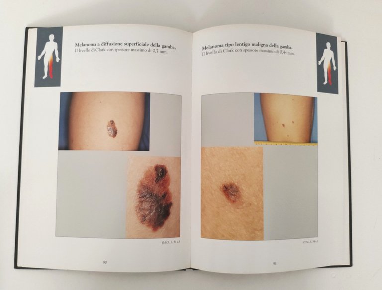 Arcangelo Morresi Melanoma della cute Atlante topografico 2 volumi Cilag …