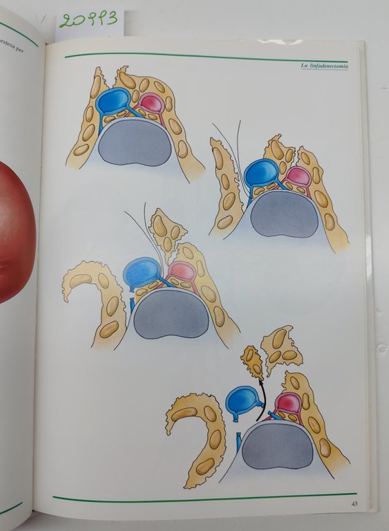 Luciano Giuliani La chirurgia del carcinoma renale atlante Zambelletti