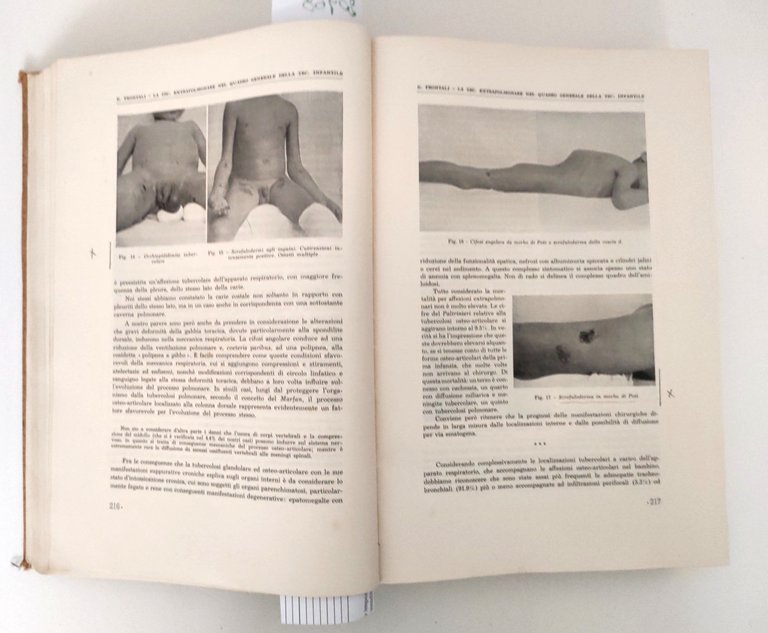Mario Donati La tubercolosi extra polmonare 2 volumi Wasserman 1936 | Immagine Gallery 6