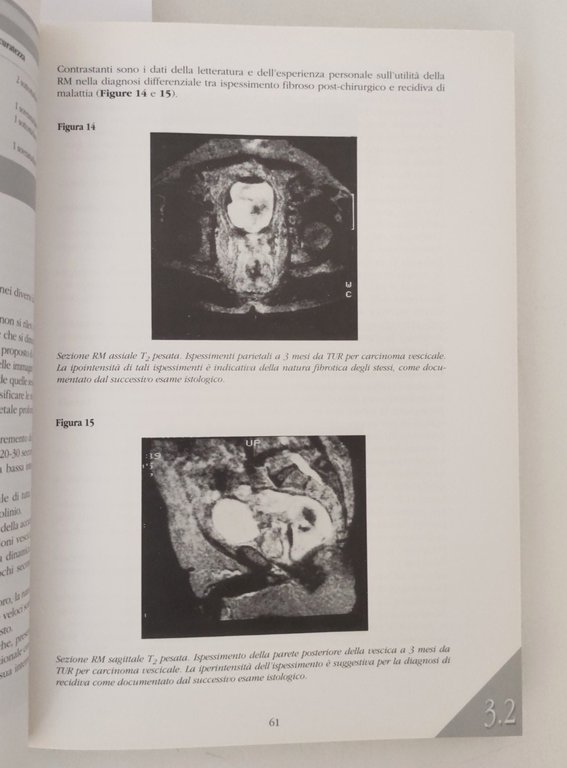 Pansadoro Sternberg Il carcinoma infiltrante della vescica Sezione Urologia 1994 | Immagine Gallery 4