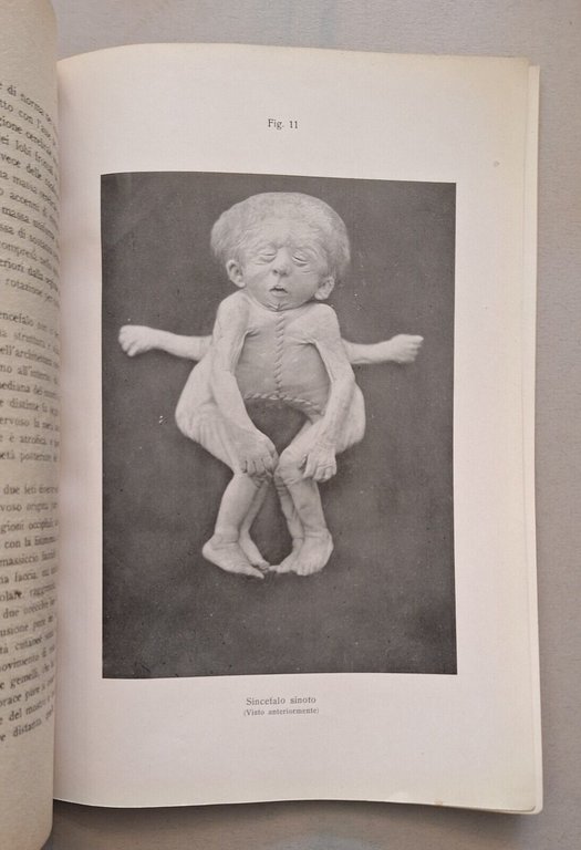 DOTT. VIRGINIO MUGGIA MOSTRI DOPPI DISOMI SIMMETRICI ED. COGLIATI 1919