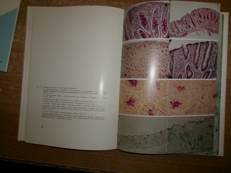 AA. VV. Aspetti eziopatogenetici ed anatomopatologici della sprue idiopatica 1966