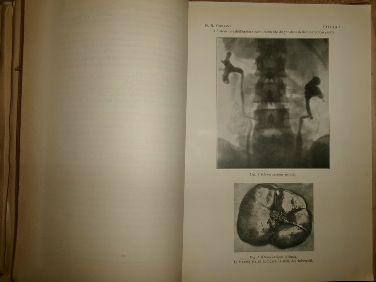 AA.VV. MISCELLANEA di numerosi opuscoli riguardanti la TUBERCOLOSI 1930