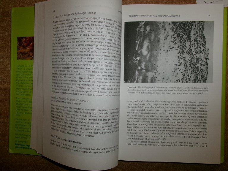 AA. VV. Thrombolysis in Cardiovascular Disease First Edition Edición 1989