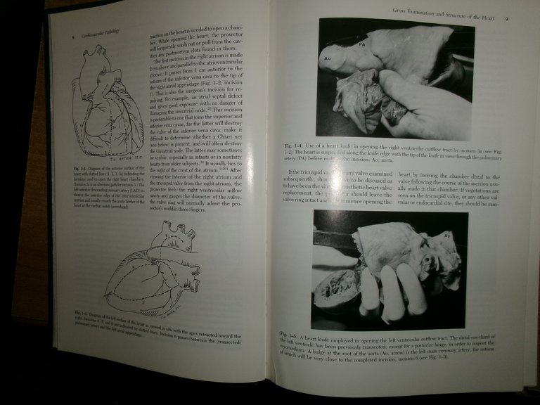 CARDIOVASCULAR PATHOLOGY Second Edition. Malcom D. Silver 2 volumi 1991