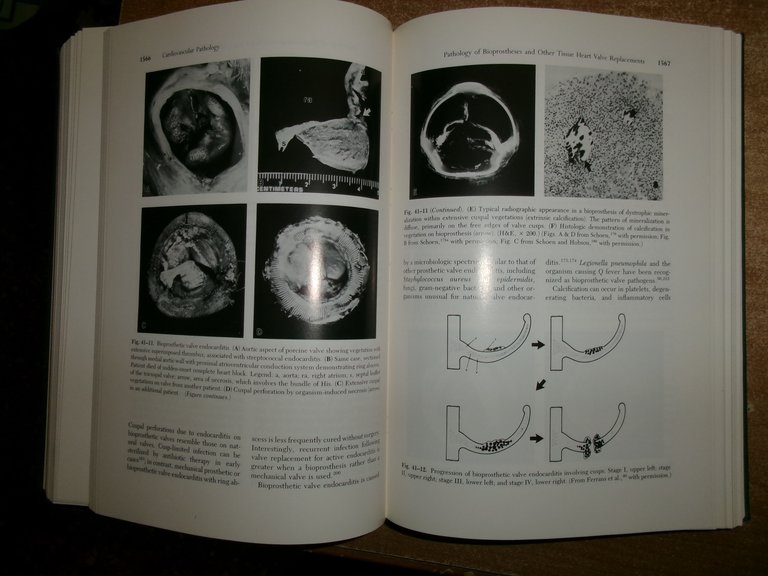 CARDIOVASCULAR PATHOLOGY Second Edition. Malcom D. Silver 2 volumi 1991