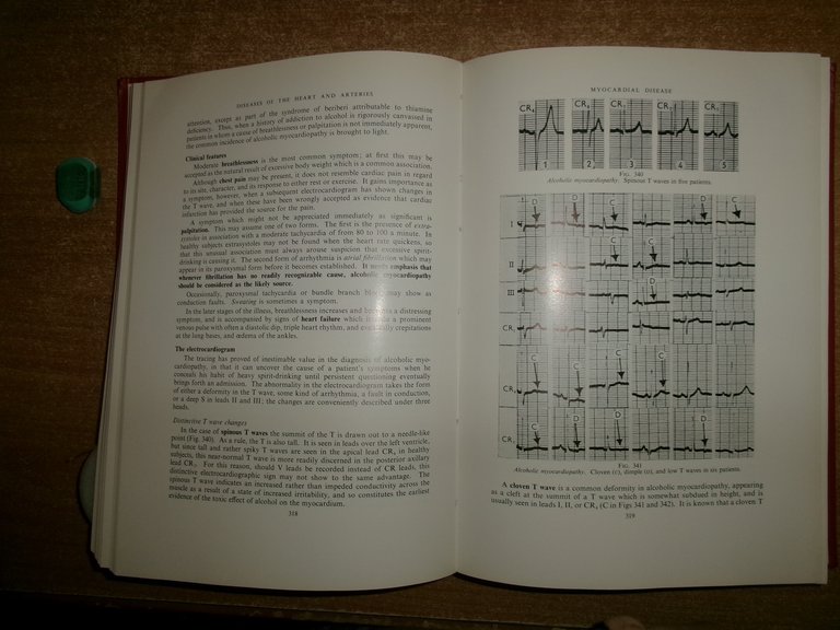 Diseases of The HEART and ARTERIES by WILLIAM EVANS 1964