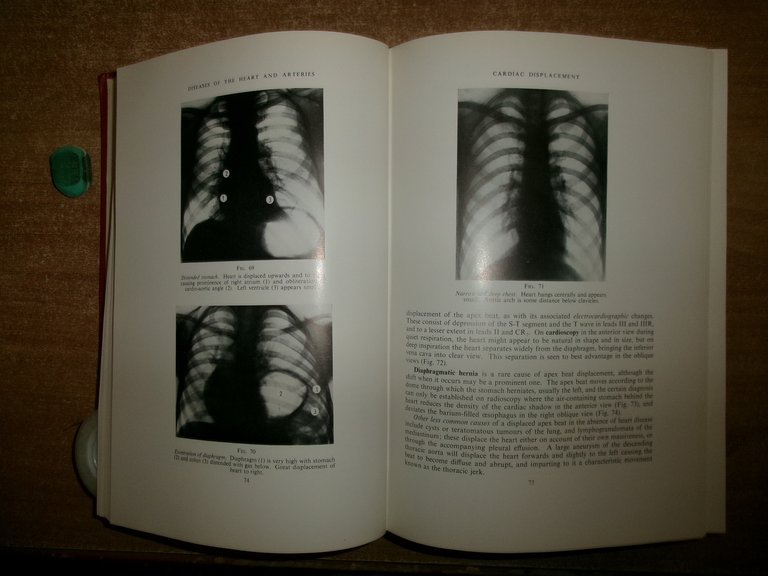 Diseases of The HEART and ARTERIES by WILLIAM EVANS 1964