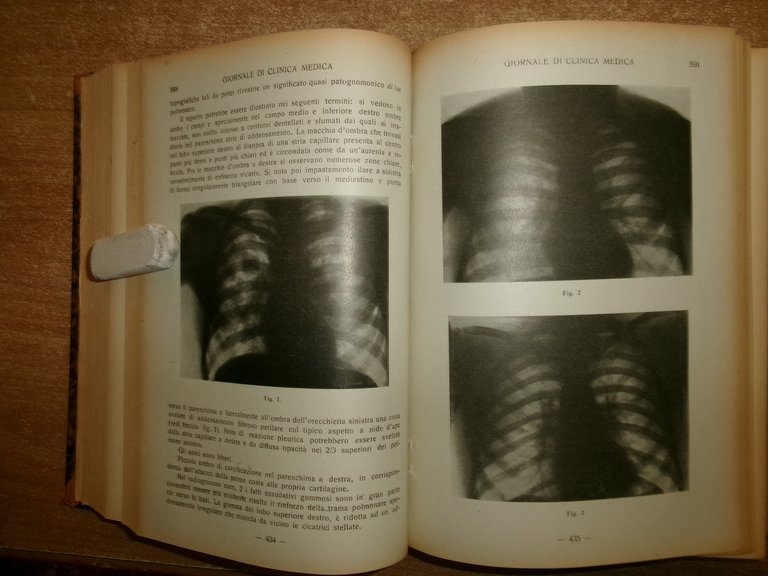 DOMENICO CAMPANACCI. Giornale di Clinica Medica 1943. 18 fascicoli legati …