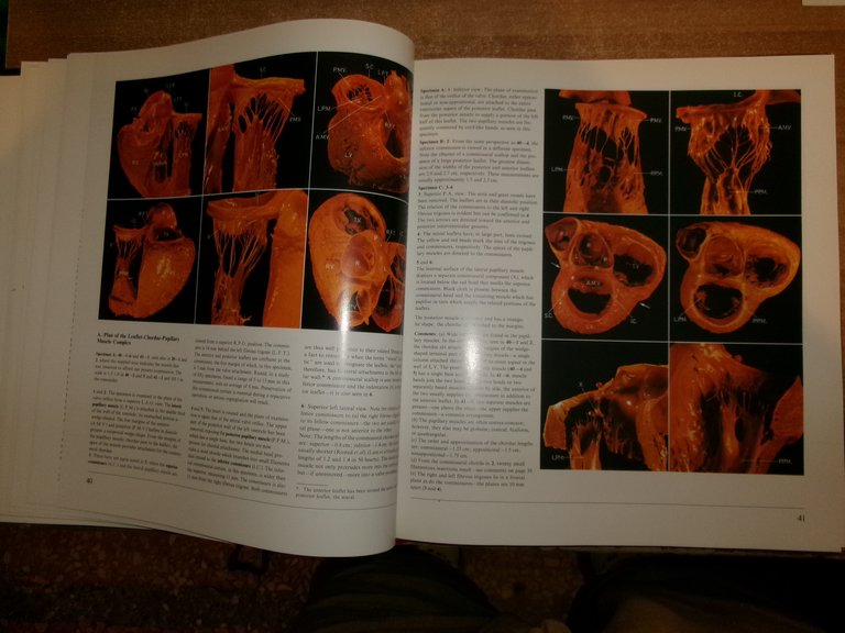 Heart and Coronary Arteries: An Anatomical Atlas for Clinical...WALLACE McALPINE