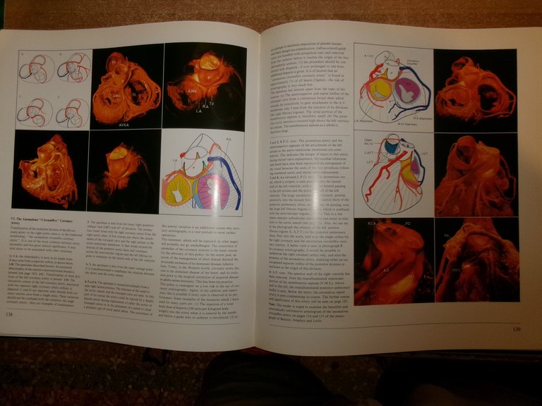 Heart and Coronary Arteries: An Anatomical Atlas for Clinical...WALLACE McALPINE