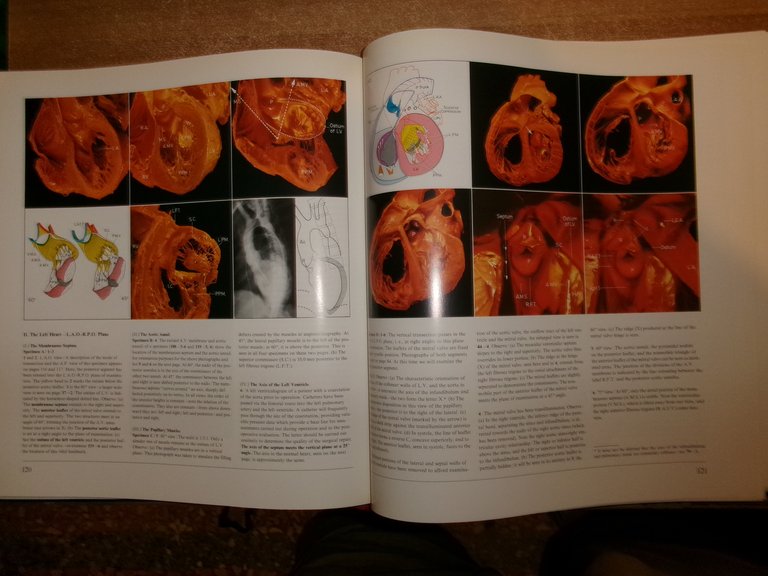 Heart and Coronary Arteries: An Anatomical Atlas for Clinical...WALLACE McALPINE