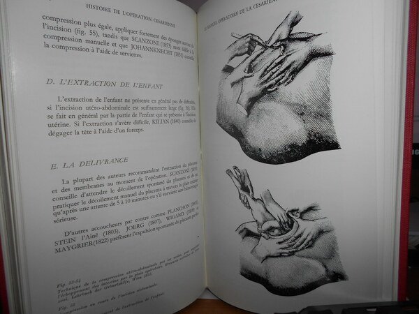 HISTOIRE de L' OPERATION CESARIENNE. Etude historique de la césarienne …