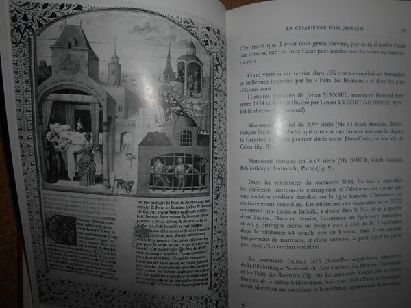 HISTOIRE de L' OPERATION CESARIENNE. Etude historique de la césarienne …