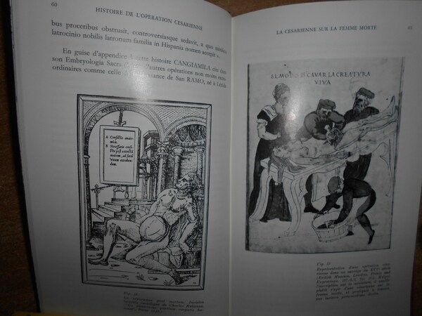 HISTOIRE de L' OPERATION CESARIENNE. Etude historique de la césarienne …