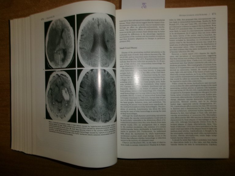 HYPERTENSION Pathophysiology, Diagnosis, and...Volume One LARAGH. BRENNER 1995