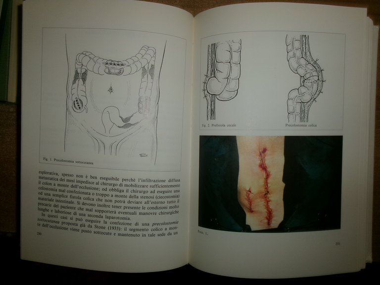 RIABILITAZIONE DEGLI STOMIZZATI di AISTOM - SILVIA EDITRICE 1989