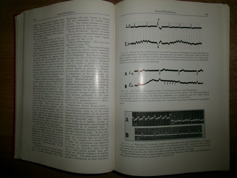 SAMUEL BELLET. Clinical Disorders of the HEART BEAT 1963