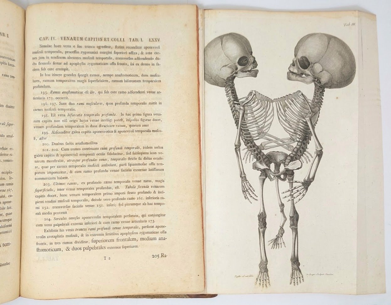 Observationes Anatomicae. Historia Monstri bicorporis duobus capitibus, tribus pedibus, pectore …