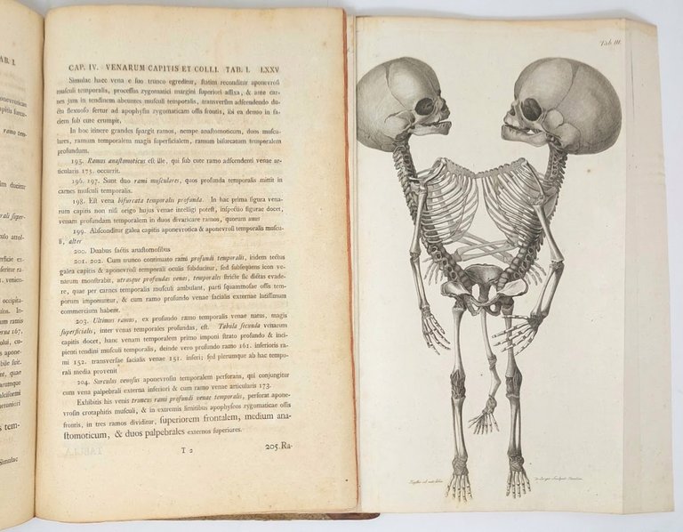 Observationes Anatomicae. Historia Monstri bicorporis duobus capitibus, tribus pedibus, pectore … | Immagine Gallery 1