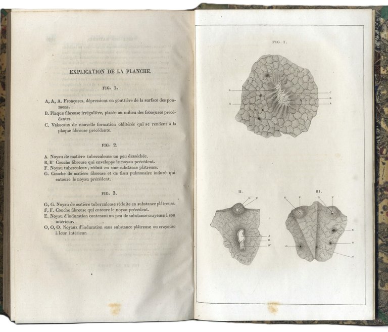 Recherches cliniques sur l&amp;rsquo;auscultation des organes respiratoires et sur la …