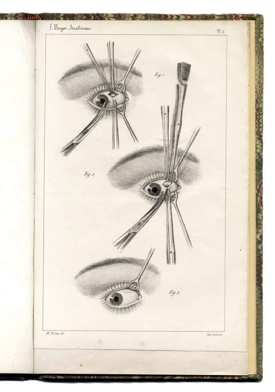 Recherches sur L'op&amp;eacute;ration du strabisme. Deuxi&amp;egrave;me M&amp;eacute;moire. | Immagine Gallery 3