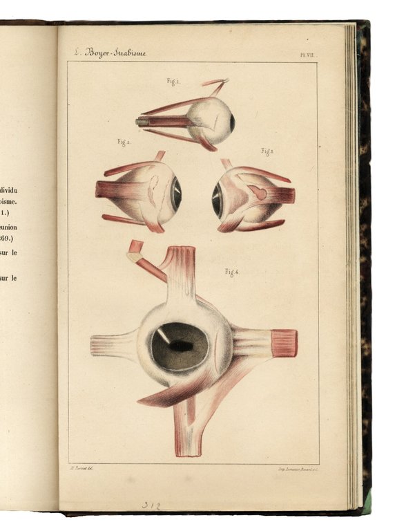 Recherches sur L'op&amp;eacute;ration du strabisme. M&amp;eacute;moire pr&amp;eacute;sent&amp;eacute; a l'Acad&amp;eacute;mie Royale … | Immagine Gallery 3