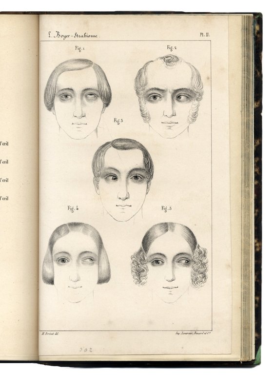 Recherches sur L'op&amp;eacute;ration du strabisme. M&amp;eacute;moire pr&amp;eacute;sent&amp;eacute; a l'Acad&amp;eacute;mie Royale … | Immagine Gallery 4