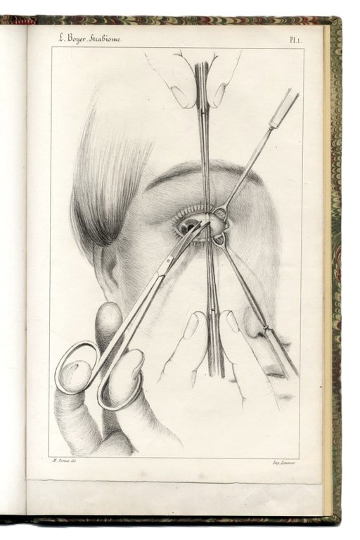 Recherches sur L'op&amp;eacute;ration du strabisme. M&amp;eacute;moire pr&amp;eacute;sent&amp;eacute; a l'Acad&amp;eacute;mie Royale … | Immagine Gallery 6