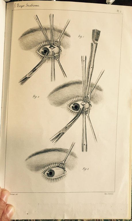 Recherches sur L'opération du strabisme. Mémoire présenté a l'Académie Royale …