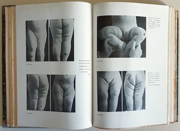 N. 3 annate complete (1935-1936-1937) della rivista medica: ATTI DELL'ACCADEMIA …