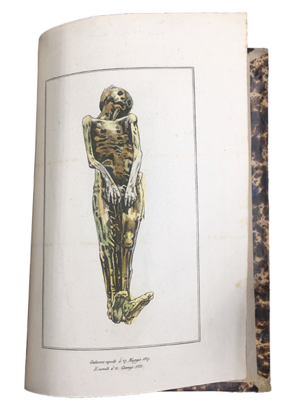 Lezioni di MEDICINA LEGALE del Professore Orfila. Edizione accresciuta di …