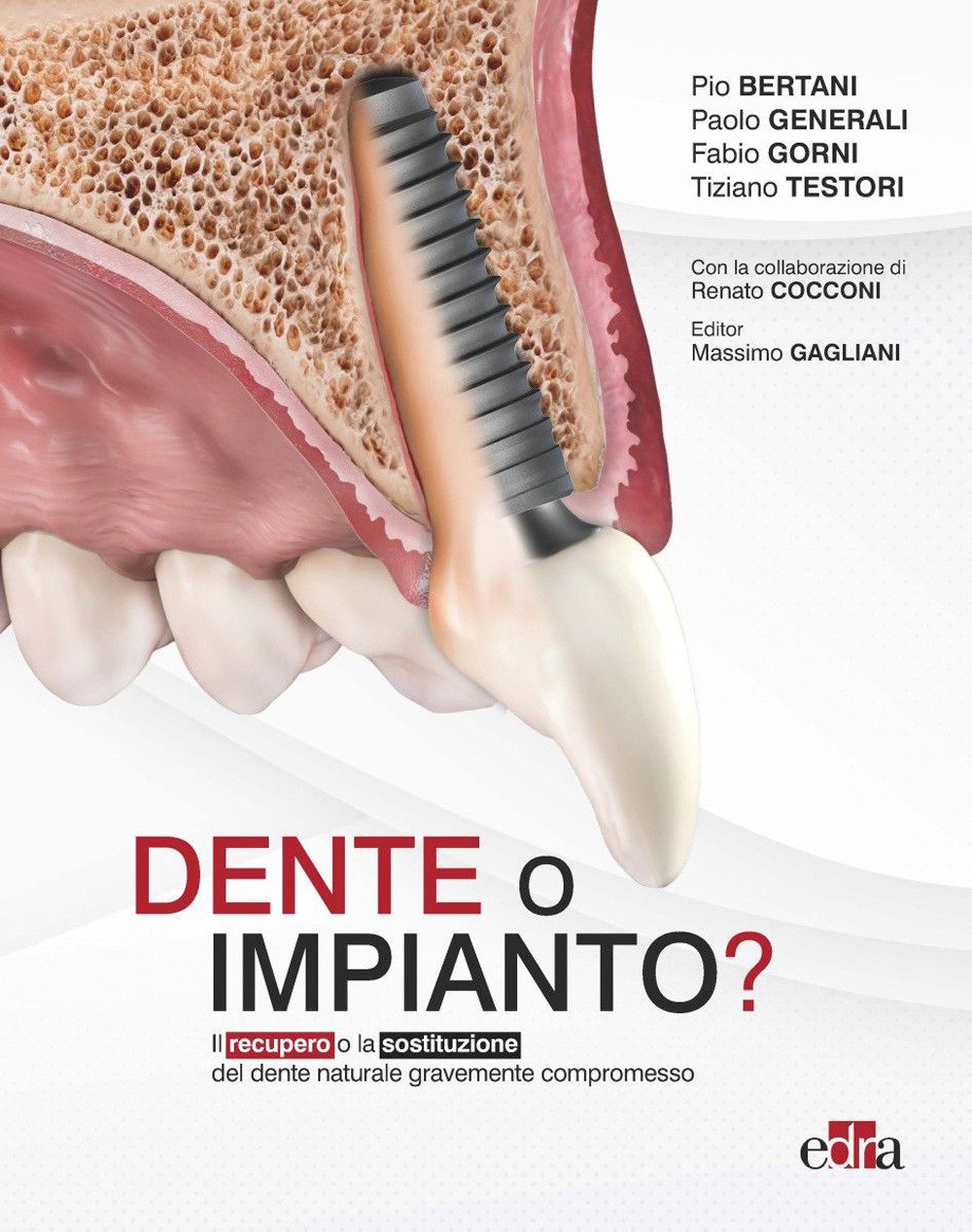 Dente o impianto? Il recupero o la sostituzione del dente …