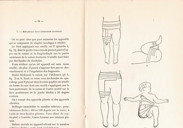 Traitement des fractures obstetricales du femur.
