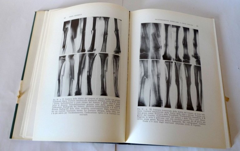 Gui,LE FRATTURE DELLA DIAFISI DEL FEMORE,1967 Gaggi[medicina,ortopedia,Küntscher
