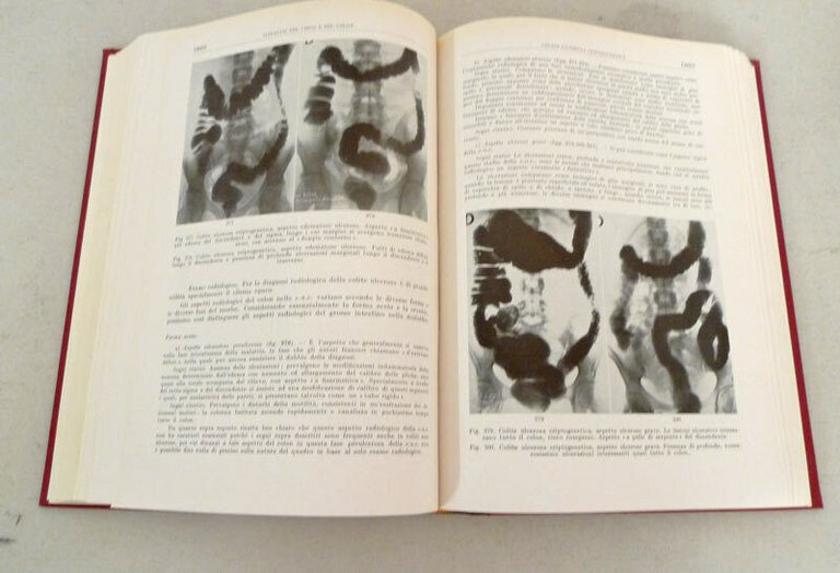 Introzzi,MALATTIE DEL CANALE DIGERENTE E DEL PERITONEO,1959[[TRATTATO MEDICINA