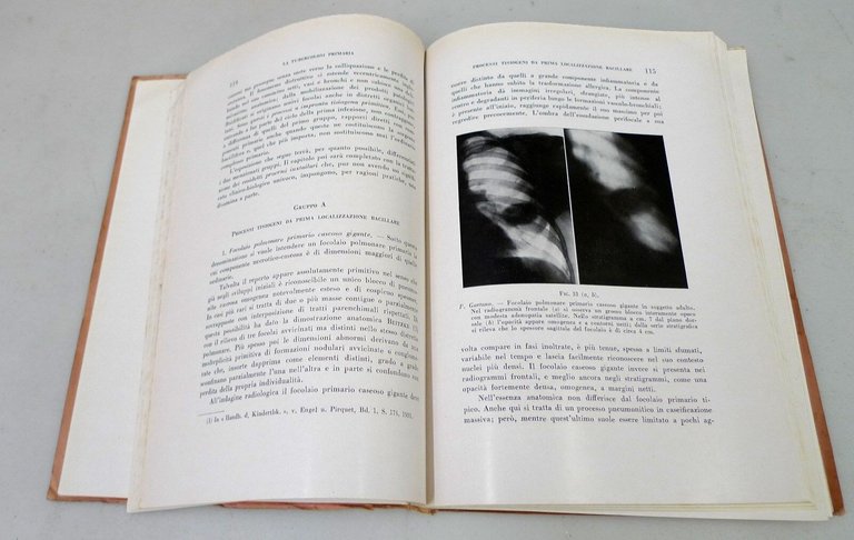Vincenzo Monaldi,PATOLOGIA DELLA TUBERCOLOSI POLMONARE,1948 Tisiologia[medicina