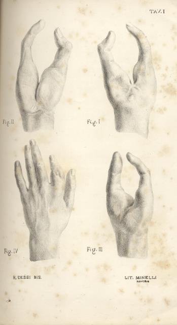 MEMORIE CHIRURGICHE. Con tavole, annessivi i quadri statistici delle malattie …