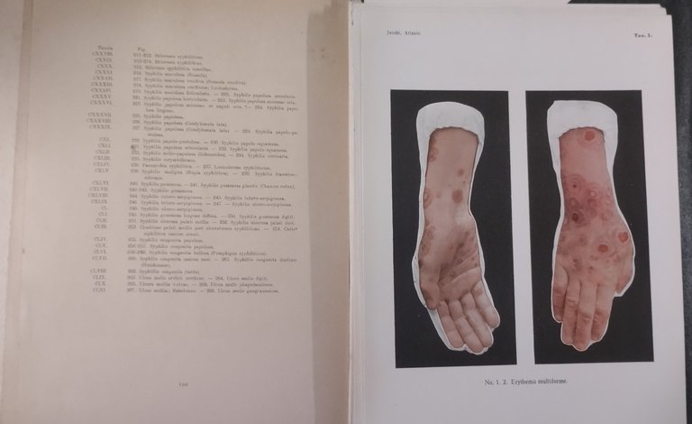 ATLANTE DELLE MALATTIE DELLA PELLE E MALATTIE VENEREE di Jacopini …