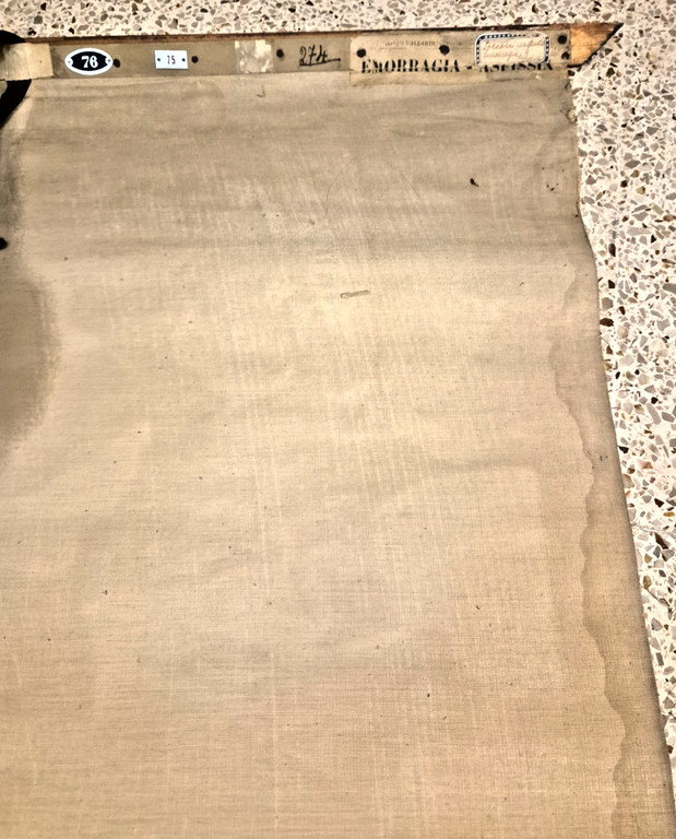 EMORRAGIA ASFISSIA POSTER DIDATTICO Vintage Tavola Paravia anni 30 infermieri