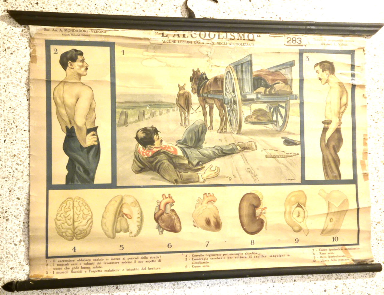 L'ALCOOLISMO lesioni organiche POSTER DIDATTICO Vintage Tavola Mondadori anni 30